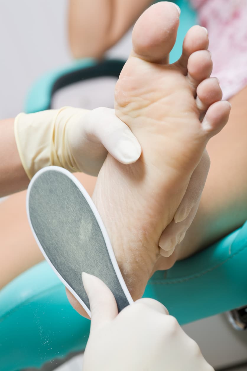 Tratamientos de durezas en los pies